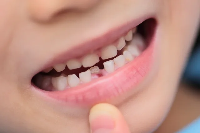 子どもの歯の着色・変色への対処法