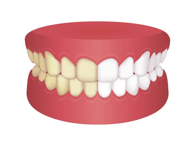 歯の黄ばみの原因となりやすい習慣や飲み物・食べ物とは？黄ばみの予防