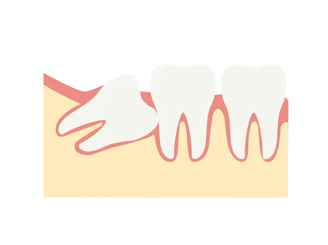 親知らずとは？なぜトラブルが起きやすいのか