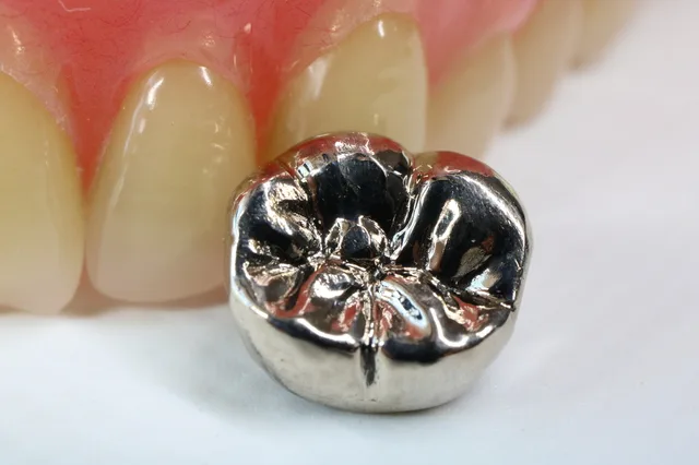 銀歯が目立つのが気になる方へ｜原因・改善方法・白い歯への治療選択を解説